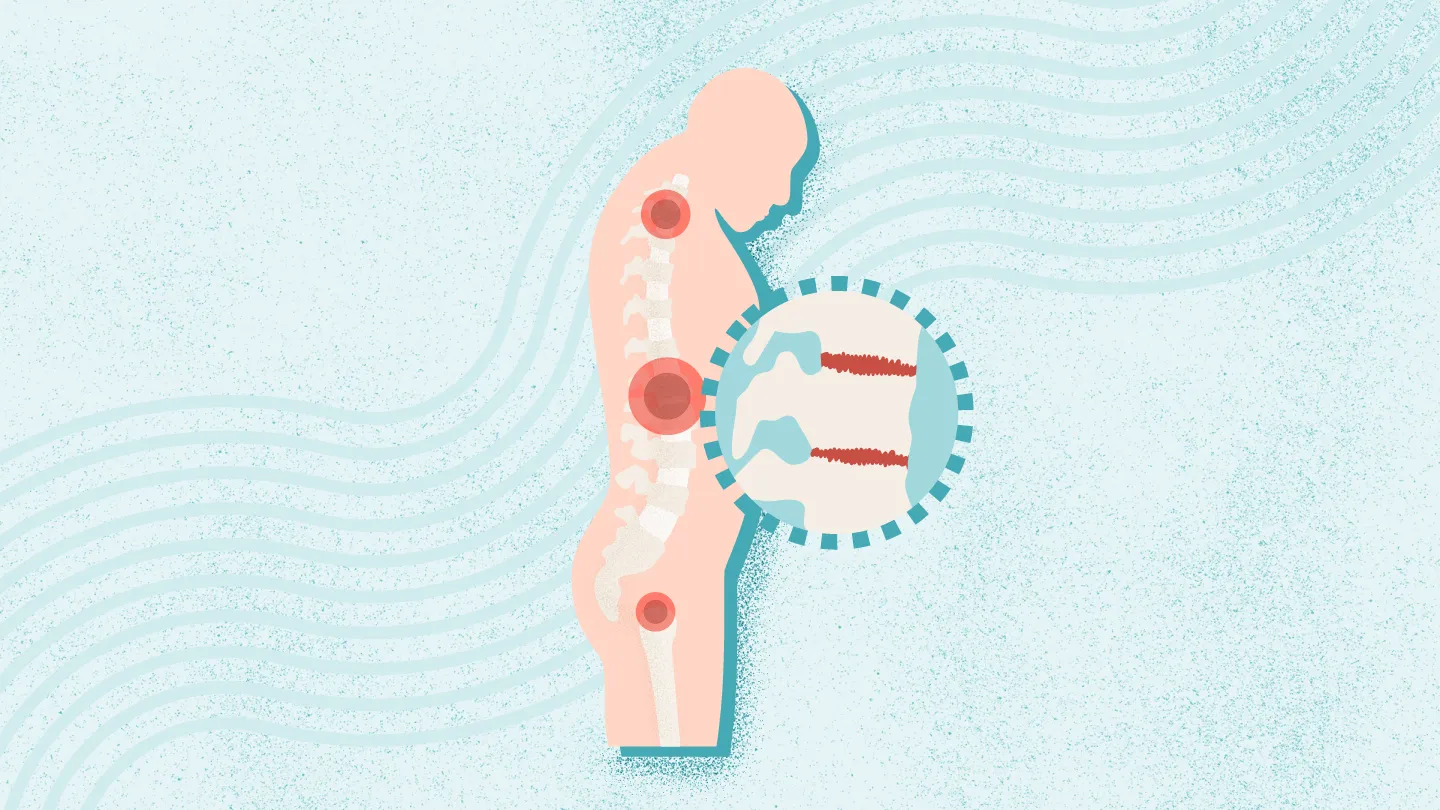 2025年干細(xì)胞治療強(qiáng)直性脊柱炎最新臨床進(jìn)展（截至12月）