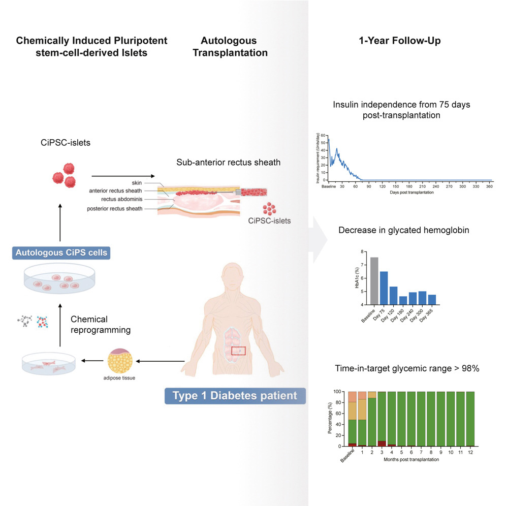 化學(xué)誘導(dǎo)多能干細(xì)胞衍生的胰島自體移植一年隨訪