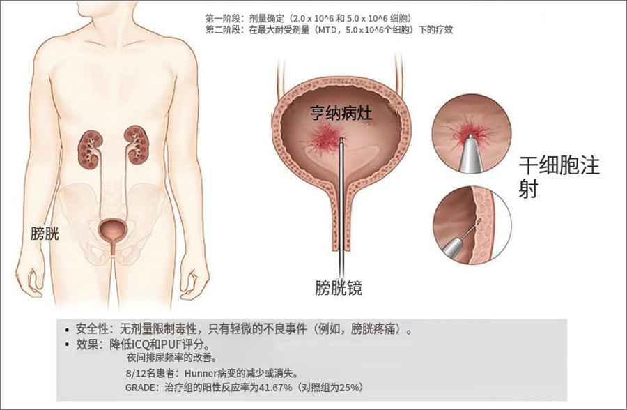 干細胞治療