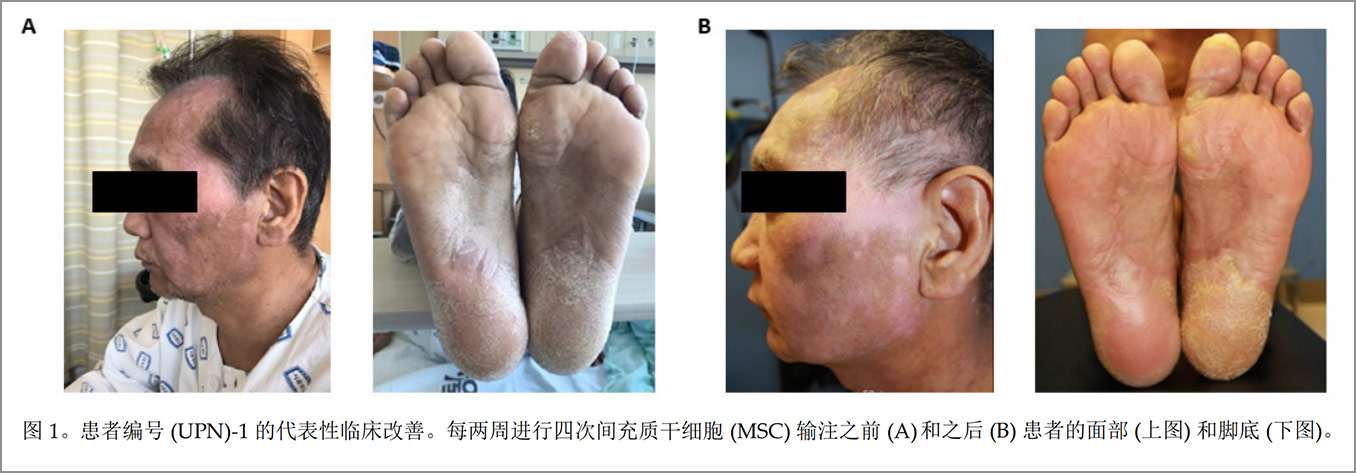 GVHD臨床試驗 GVHD臨床試驗