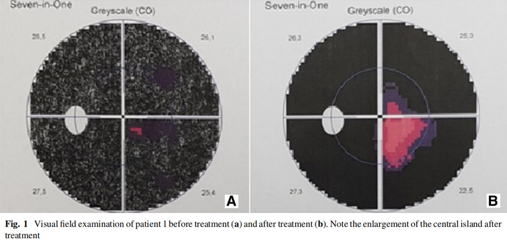 視神經(jīng)萎縮臨床試驗 視神經(jīng)萎縮臨床試驗
