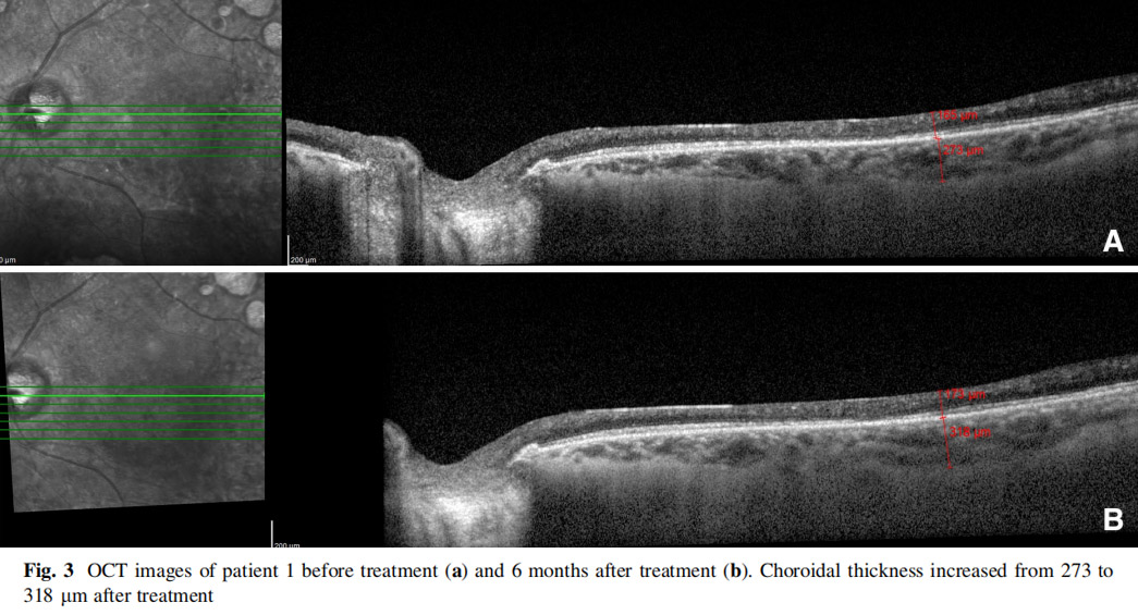 視神經(jīng)萎縮臨床試驗 視神經(jīng)萎縮臨床試驗