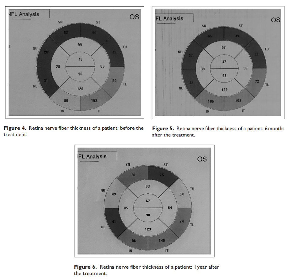 視神經(jīng)萎縮臨床試驗 視神經(jīng)萎縮臨床試驗