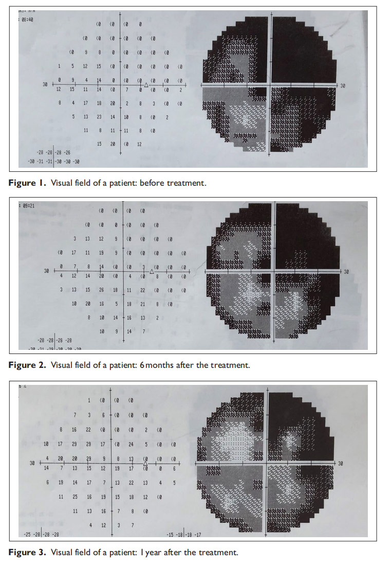 視神經(jīng)萎縮臨床試驗 視神經(jīng)萎縮臨床試驗