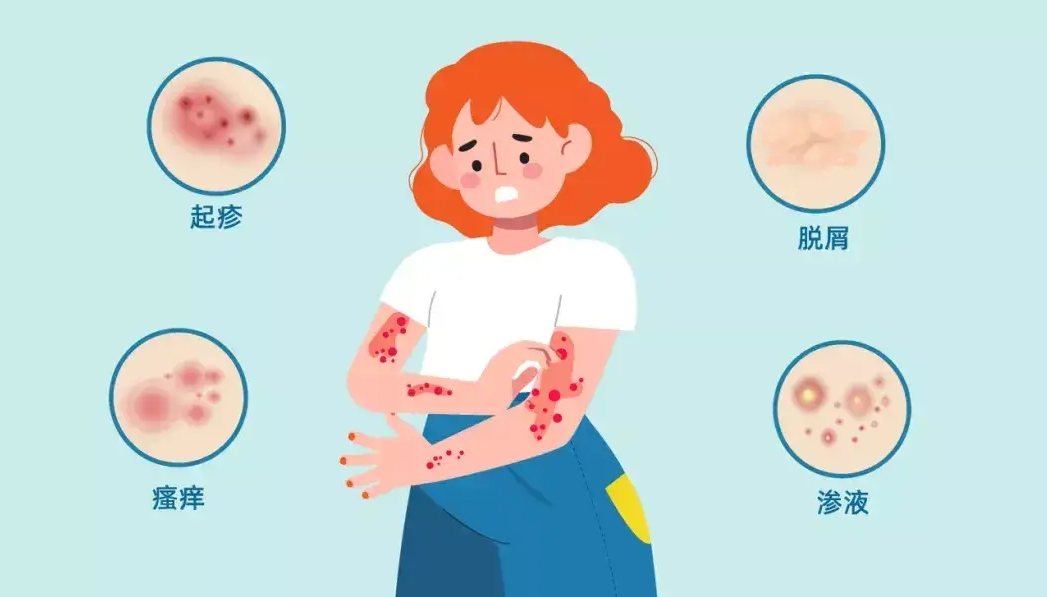 特應(yīng)性皮炎 特應(yīng)性皮炎