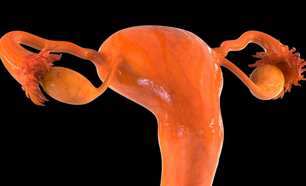 宮腔粘連 宮腔粘連