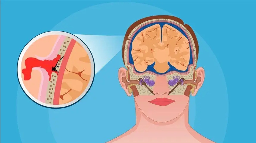 創(chuàng)傷性腦損傷 創(chuàng)傷性腦損傷