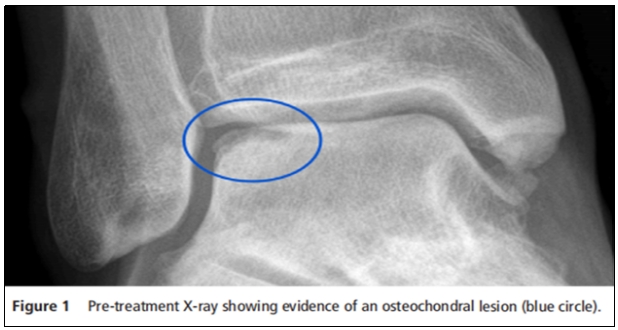 “軟骨損傷”/ 軟骨損傷