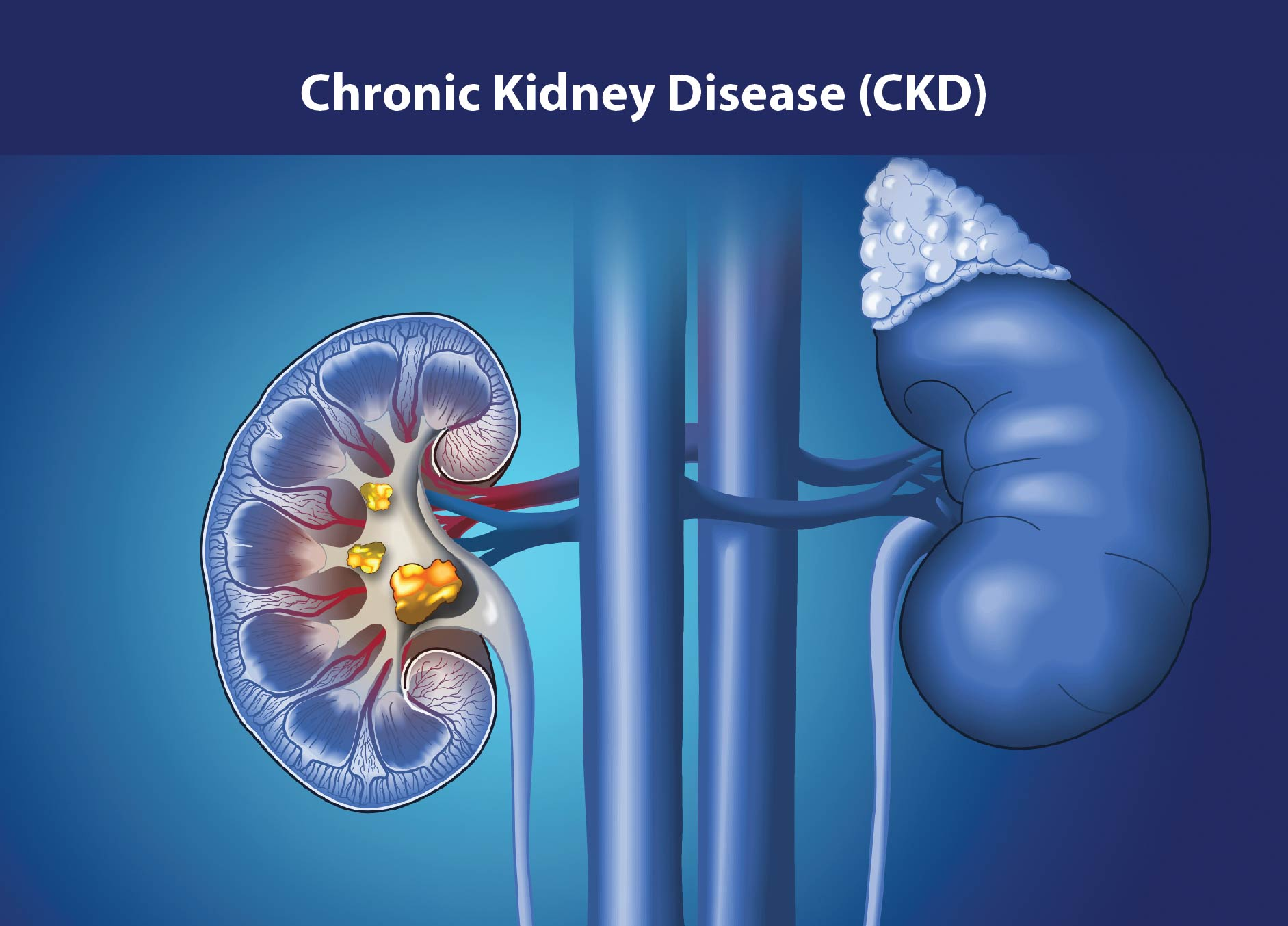 慢性腎病治療新策略：間充質(zhì)干細胞如何修復(fù)腎功能、延緩疾病進展？