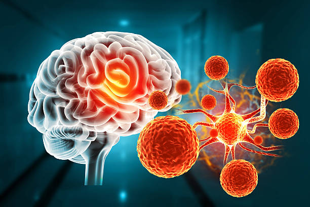 干細(xì)胞治療帕金森病取得新進(jìn)展！II期臨床證實：三次輸注，安全且運(yùn)動功能得到改善