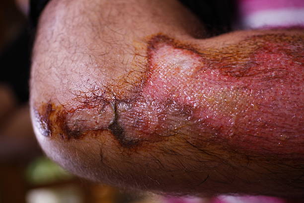 干細胞修復面部深度燒傷:1例患者術(shù)后面部基本恢復正常 | 成功案例 干細胞修復面部深度燒傷:1例患者術(shù)后面部基本恢復正常 | 成功案例