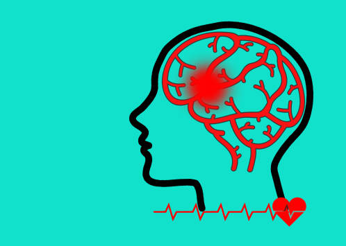 哪些中風(fēng)患者適合干細(xì)胞治療？專家公布了5大評(píng)估標(biāo)準(zhǔn)