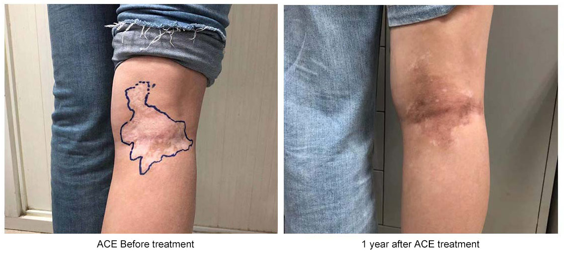 干細(xì)胞移植前后白癜風(fēng)癥狀改變