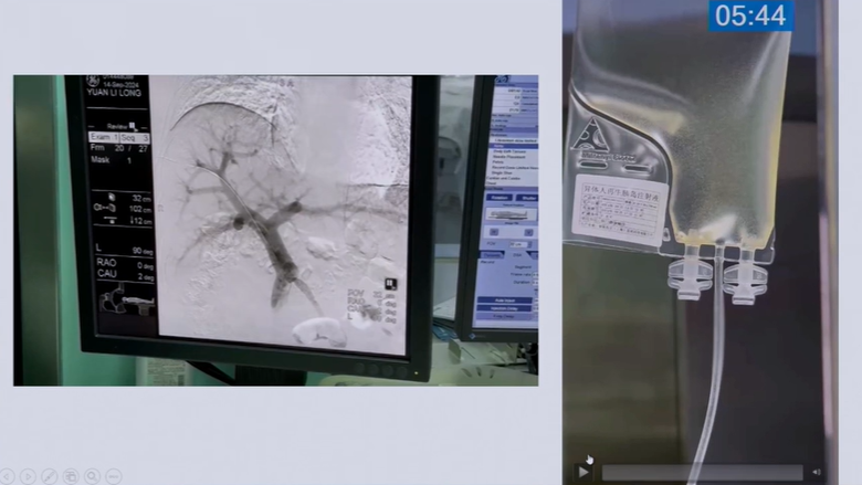 殷浩教授展示了干細(xì)胞療法的治療過程