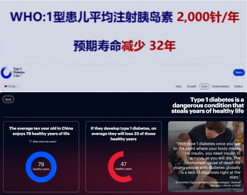 2025｜間充質(zhì)干細(xì)胞療法治療1型糖尿?。含F(xiàn)狀與臨床進(jìn)展