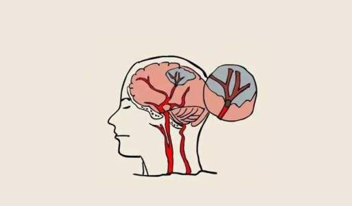 中風(fēng)后的腦損傷，真的能被干細(xì)胞療法逆轉(zhuǎn)嗎？