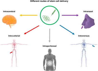干細胞移植途徑：該圖展示了用于中風治療的干細胞輸送途徑，包括腦內(nèi)（立體定向注射）、血管內(nèi)（靜脈/動脈）、腹腔內(nèi)、腦室內(nèi)、靜脈內(nèi)、鼻內(nèi)和鞘內(nèi)注射方法。