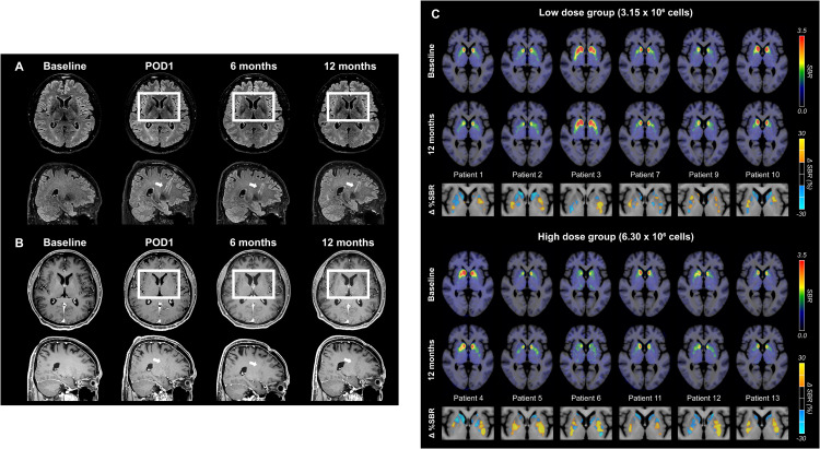 圖6：代表性腦部MRI圖像以及A9-DPC移植后18F -FP-CIT攝取量的個(gè)體水平變化