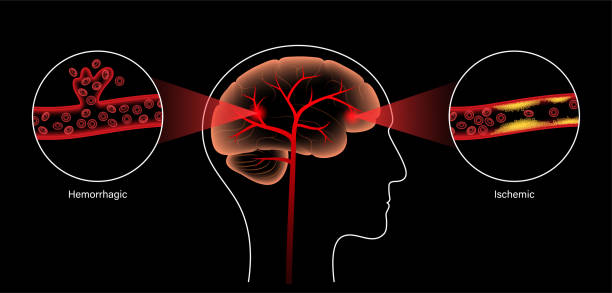 臍帶干細胞靜脈注射治療腦卒中？Ⅰ期人體研究結(jié)果公布：臨床顯示安全有效